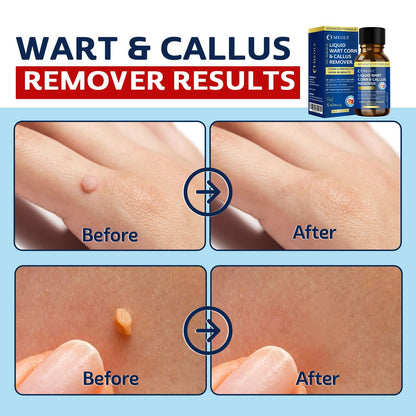 MEOLY Fast-Acting Wart Remover Freeze Off : Wart Remover for Men Women - Wart Removal for Plantar Wart, Common Wart, Flat Wart 30 ML