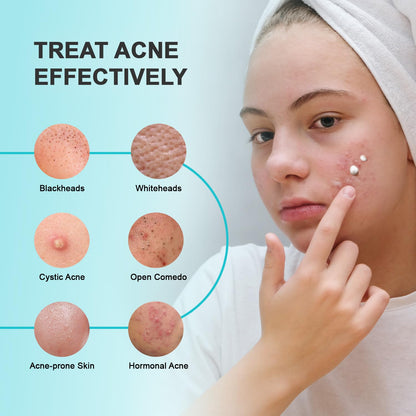 Acne Pimple Spot Treatment Cream: Cystic Hormonal Blackheads Blemish Remover for Face, Back and Body - with 10% Azelaic Acid - Teens 13-19 & Young Adult 20-30, 1.8 oz