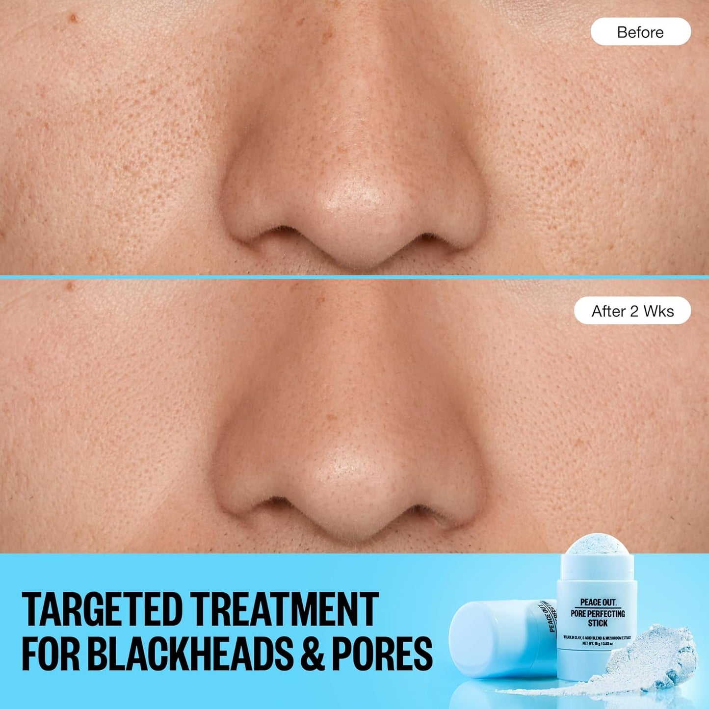 PEACE OUT Pore Perfecting Stick Acne Solution & Blackhead Remover, Glycolic Acid & Salicylic Acid Cleanser, Works Like a Face Wash, Skincare Facial Cleanser & Exfoliating Facial Scrub, 15g /0.53oz