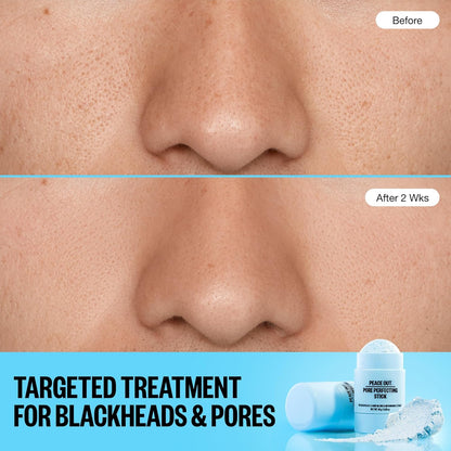 PEACE OUT Pore Perfecting Stick Acne Solution & Blackhead Remover, Glycolic Acid & Salicylic Acid Cleanser, Works Like a Face Wash, Skincare Facial Cleanser & Exfoliating Facial Scrub, 15g /0.53oz