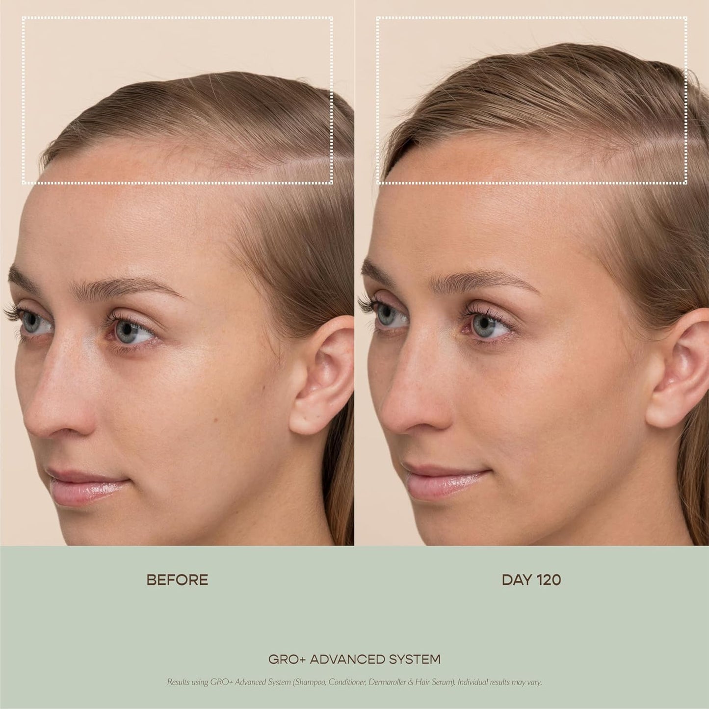 VEGAMOUR GRO+ Advanced Dermaroller | 1,200 Microneedle 0.25mm Scalp Tool | Gently Exfoliates the Scalp | Wide Head for Maximum Coverage